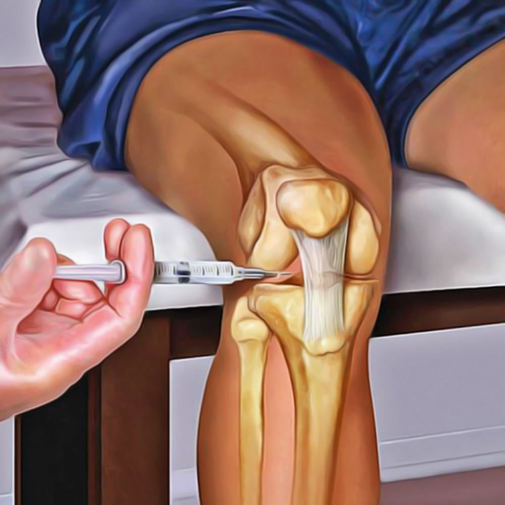 Ilustração de infiltração articular no joelho, com a agulha posicionada no espaço da articulação